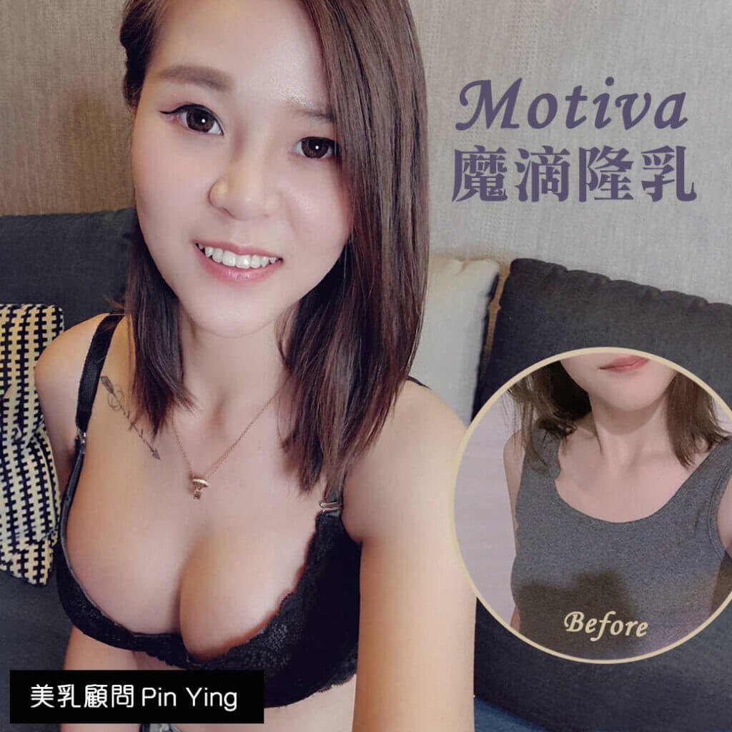 【元和雅隆乳評價】我做魔滴隆乳術後滿1個月囉 魔滴隆乳術後心得 5 隆乳術後