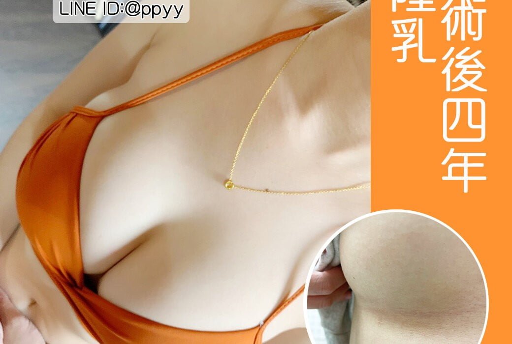 隆乳心得術後4年追蹤完整記錄2.0，柔軟度與恢復期分享 魔滴隆乳