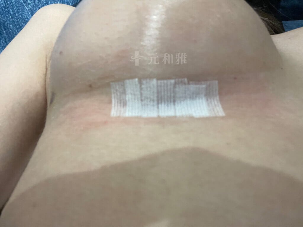 0701術後美容膠帶貼法
